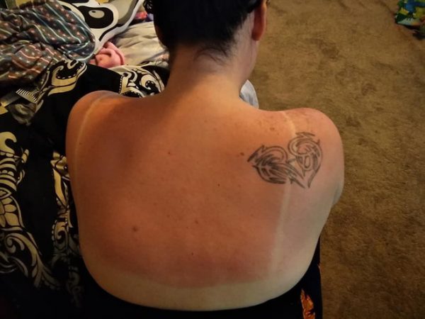 Đây là làn da của cô Cindi khi bị cháy nắng.