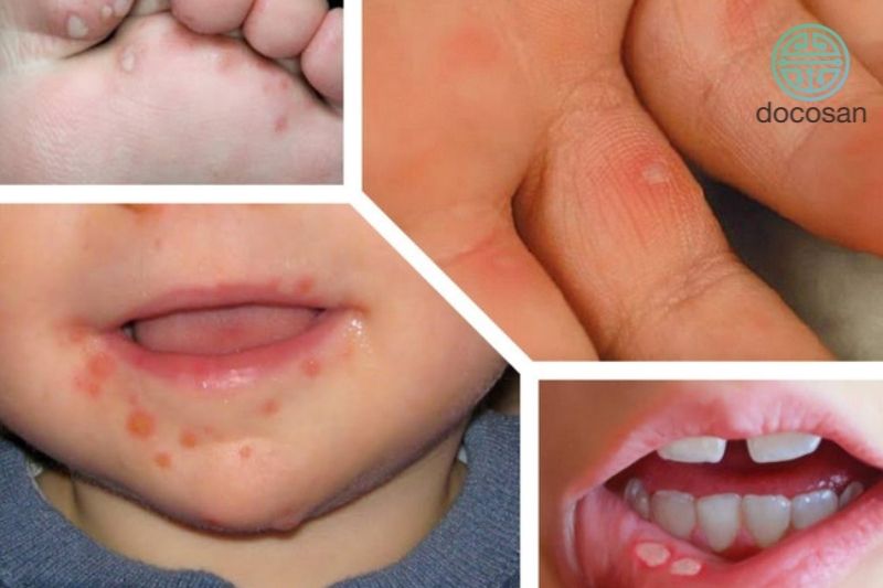 Bệnh tay chân miệng ở trẻ có tự khỏi không?