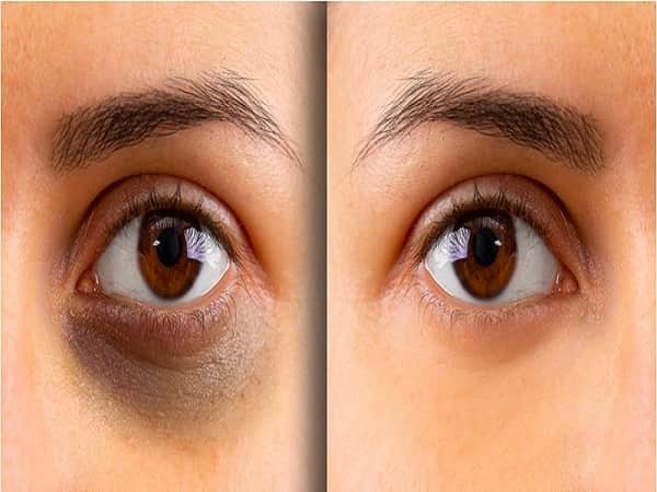 Cách giảm thâm mắt hiệu quả