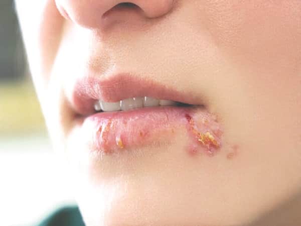 Nguyên nhân gây Herpes môi