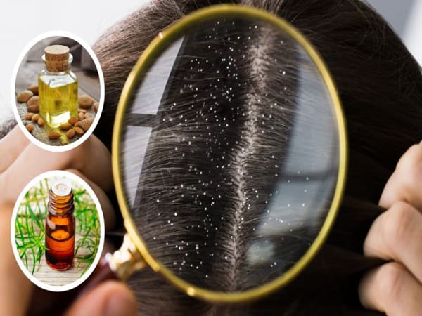 Cách trị gàu dứt điểm với dầu Tràm trà