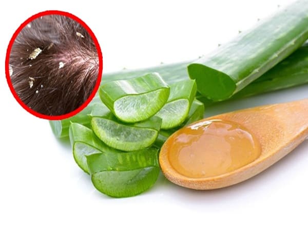 Cách trị gàu dứt điểm tại nhà bằng nguyên liệu tự nhiên