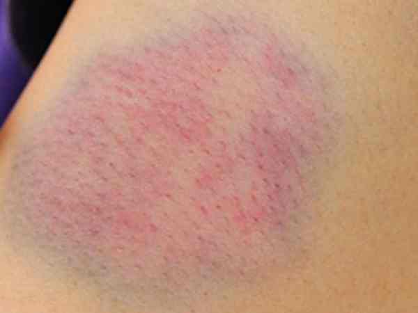 Triệu chứng nhận biết bệnh máu loãng là gì? Bệnh máu loãng dễ xuất hiện các vết bầm tím lớn mà không rõ nguyên nhân.